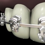 braces